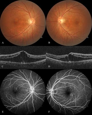 Case Report: Intravitreal dexamethasone implant as adjuvant treatment for taxane-related cystoid macular edema